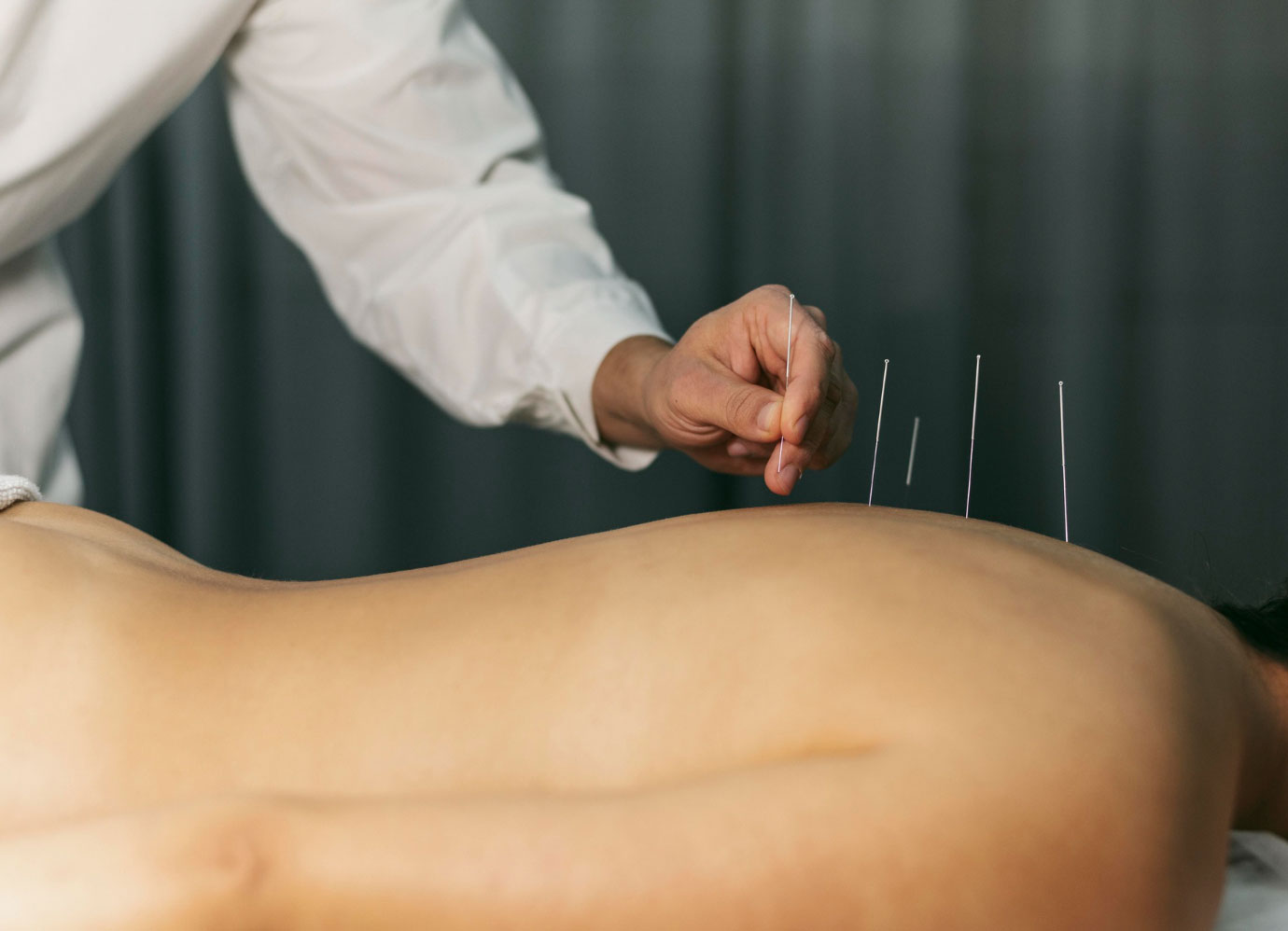 Akupunktúra kezelés - akupunktúrás tűk a háton
